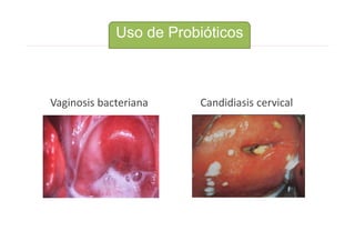 Vaginosis bacteriana Candidiasis cervical
Uso de Probióticos
 