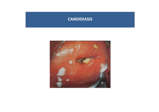 CANDIDIASIS
 
