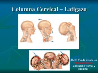 Columna Cervical – Latigazo ¡OJO! Puede existir un Whiplash brain -Contusión frontal y occipital- 