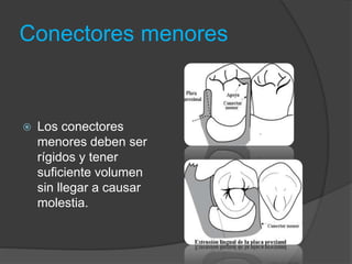 Conectores menores
 Los conectores
menores deben ser
rígidos y tener
suficiente volumen
sin llegar a causar
molestia.
 