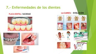 7.- Enfermedades de los dientes
LA CARIES: EVOLUCIÓNPLACA DENTAL: SUCIEDAD
 