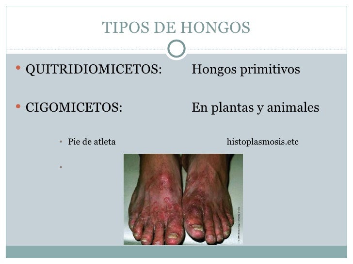 Irunin el esquema de la aplicación al hongo de las uñas