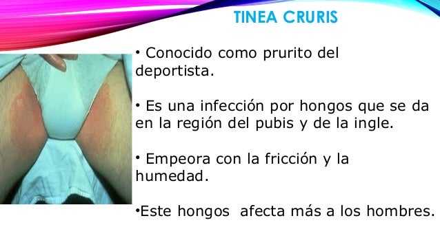 La tintura del propóleos para el tratamiento del hongo sobre las uñas