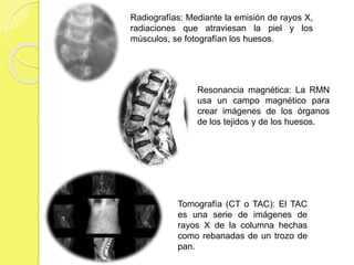 Radiografías: Mediante la emisión de rayos X,
radiaciones que atraviesan la piel y los
músculos, se fotografían los huesos.
Resonancia magnética: La RMN
usa un campo magnético para
crear imágenes de los órganos
de los tejidos y de los huesos.
Tomografía (CT o TAC): El TAC
es una serie de imágenes de
rayos X de la columna hechas
como rebanadas de un trozo de
pan.
 