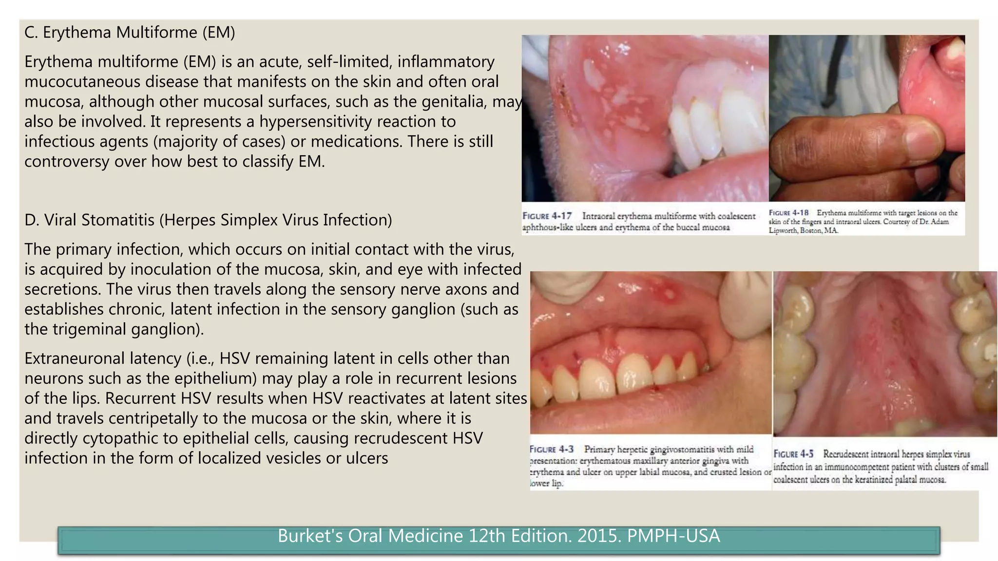 Major Ras Reccurent Aphthous Stomatitis (RAS) / Stomatitis Aftosa Rekuren | PPTX