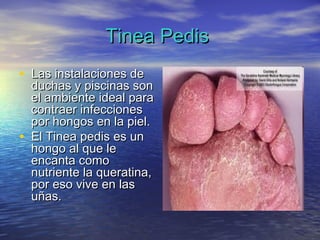 Tinea Pedis
• Las instalaciones de
    duchas y piscinas son
    el ambiente ideal para
    contraer infecciones
    por hongos en la piel.
•   El Tinea pedis es un
    hongo al que le
    encanta como
    nutriente la queratina,
    por eso vive en las
    uñas.
 