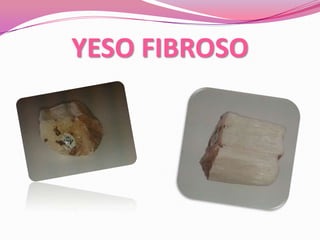 YESO FIBROSO
 