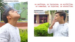 se perforan, se incrustan, se acribillan,
se remachan, se injertan, se atornillan,
ESPACIO NASAL NORMAL
MUCHO ESPACIO NASAL
 