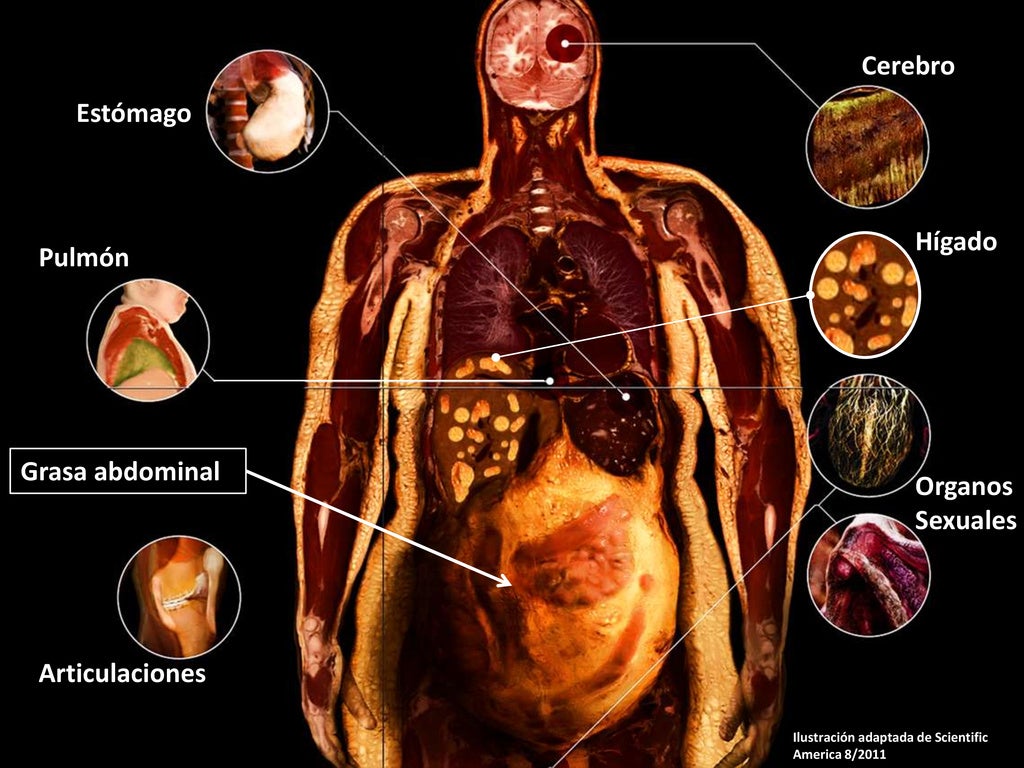Los problemas ocultos de la obesidad