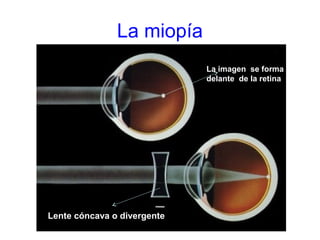 La miopía
Lente cóncava o divergente
La imagen se forma
delante de la retina
 