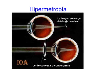 Hipermetropía
La imagen converge
detrás de la retina
Lente convexa o convergente
 