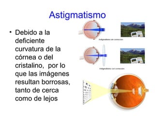Astigmatismo
• Debido a la
deficiente
curvatura de la
córnea o del
cristalino, por lo
que las imágenes
resultan borrosas,
tanto de cerca
como de lejos
 