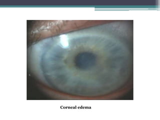 Corneal edema
 
