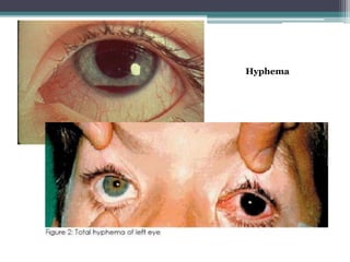 Hyphema
 