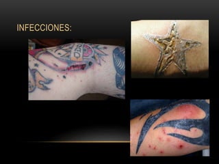 INFECCIONES:
 