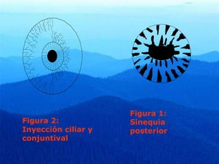 Figura 2:
Inyección ciliar y
conjuntival
Figura 1:
Sinequia
posterior
 