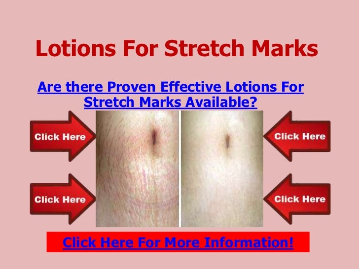 How To Remove Stretch Marks | Lotions for stretch marks