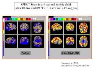 Before After Mild HBO SPECT Scans in a 4 year old autistic child  after 10 dives mHBOT at 1.3 atm and 24% oxygen Heuser et...