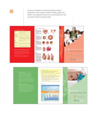 in these examples, i combined existing medical
                                                                     illustrations with original medical writing. Again, the
                                                                     folders are prepared as part of a presentation for the
                                                                     purpose of pharma sponsorship.




                                                                                    !   &                      !

 &                       ! &       !      #       "
     " !                    *'5' &47)5 *'.2 ;174 $1&; )'6 4+& 1( ':64#
                           51&+7/ #0& (.7+& 51 6*#6 ;174 $.11& 8'55'.5 &10 6
                           *#8' 61 *1.& 51 /7%* (.7+&

     !                         *'5' &47)5 $.1%- 6*' '(('%65 1( #&4'0#.+0'

                               *'5' &47)5 *'.2 ;174 $.11& 8'55'.5 56#; 12'0

                 !          *'5' &47)5 24'8'06 ;174 $.11& 8'55'.5 (41/
                           %10564+%6+0) $; 4'&7%+0) *19 /7%* #0)+16'05+0
                           ;174 $1&; /#-'5 0)+16'05+0 +5 # %*'/+%#. 6*#6
                           %10564+%65 $.11& 8'55'.5 /#-'5 6*'/ /14' 0#4419

                            *'5' &47)5 914- $; $.1%-+0) 6*' '(('%6 1(
                           #0)+16'05+0 10 %'..5

         "
                            *'5' &47)5 *'.2 24'8'06 ;174 $.11& 8'55'.5 (41/
                           %10564+%6+0) $; $.1%-+0) %#.%+7/ (41/ '06'4+0) ;174
                           %'..5

             !               *'5' &47)5 %1/$+0' 691 /'&+%+0'5 .+-' #0
                           +0*+$+614 14 # $'6# $.1%-'4 2.75 # &+74'6+%




         !           !                                  !                                                                                                                                                            +)* .11& 4'5574'
  +(('4'06 &47)5 *#8' &+(('4'06 5+&' '(('%65 (14 &+(('4'06 2'12.' +&'
'(('%65 1( #06+*;2'46'05+8' &47)5 %#0 +0%.7&' (''.+0) &+<<; 9*'0 ;17
                                                                                                                                                                                                                 "             !   "
56#0& 72 #(6'4 .;+0) &190 14 5+66+0) .19'4'& .'8'.5 1( 216#55+7/ +0 ;174
$.11& 241$.'/5 5.''2+0) &4195+0'55 &4; /176* *'#&#%*'5 $.1#6+0)
%1056+2#6+10 #0& &'24'55+10 0 /'0 51/' #06+*;2'46'05+8' &47)5 %#0
%#75' 241$.'/5 9+6* *#8+0) #0 '4'%6+10
 #.- 61 ;174 (#/+.; &1%614 #$176 #0; %*#0)'5 ;17 016+%' ( 10'
/'&+%+0' &1'50 6 914- (14 ;17 14 %#75'5 5+&' '(('%65 ;17 *#8'
16*'4 126+105 '6 ;174 &1%614 *'.2 (+0& 6*' 4+)*6 /'&+%+0' (14 ;17




                                                                                                                         #
                                                                                        = 92,' 25 /,0,7 <285 86( 2) &$))(,1( &2))(( 7($ &$))(,1$7(' 62'$
                                                                                         &+2&2/$7( '(&21*(67$176 $/&2+2/ $1' 72%$&&2
                           16201,$ ,6 <285 %2'<?6 :$< 2) 6$<,1* 7+$7                    = ;(5&,6( 5(*8/$5/< %87 '21?7 (;(5&,6( :,7+,1 $ )(: +2856 %()25( *2,1* 72
                          620(7+,1* ,61?7 5,*+7 +,1*6 7+$7 0$< &$86(                     %('
                          ,16201,$ ,1&/8'( 675(66 722 08&+ &$))(,1(                     = ,1' :$<6 72 5('8&( 25 0$1$*( 7+( 675(66 ,1 <285 /,)(
                          '(35(66,21 &+$1*(6 ,1 :25. 6+,)76 $1' 3$,1                    =         21?7 /,( ,1 %(' :255<,1* $%287 7+,1*6 (7 $6,'( $127+(5 7,0( -867 )25
                          )520 0(',&$/ 352%/(06 68&+ $6 $57+5,7,6                                :255<,1* 25 (;$03/( 63(1' 0,187(6 $)7(5 ',11(5 :5,7,1* '2:1
                                                                                                 :+$7?6 :255<,1* <28 $1' :+$7 <28 &$1 '2 $%287 ,7
                            $1< 3(23/( +$9( ,16201,$ (23/( :+2 +$9(                     = 5< ($7,1* $ /,*+7 61$&. %()25( *2,1* 72 %(' %87 '21?7 ($7 722 08&+
                          ,16201,$ 0$< 127 %( $%/( 72 )$// $6/((3 +(< 0$<                5,*+7 %()25( %('7,0( */$66 2) :$50 0,/. 25 620( &+((6( $1'
                          :$.( 83 '85,1* 7+( 1,*+7 $1' 127 %( $%/( 72 )$//               &5$&.(56 0$< %( $// <28 1(('
                          %$&. $6/((3 25 7+(< 0$< :$.( 83 722 ($5/< ,1 7+(              = 21?7 1$3 '85,1* 7+( '$< ,) 1$36 6((0 72 0$.( <285 ,16201,$ :256(
                          0251,1*


                            (77,1* (128*+ 6/((3 ,6 $1 ,03257$17 3$57 2) $                 Non-REM                        As you fall asleep, you enter non-REM sleep, which comprises of Stages 1 – 4 *
                          +($/7+< /,)(67</( 16201,$ &$1 $))(&7 <28 0(17$//<               75–80% of sleep

                          $1' 3+<6,&$//< 7 &$1 0$.( <28 )((/ 7,5(' '(35(66('                  Stage 1 *                  Drowsiness and light sleep.

                          $1' ,55,7$%/( 7 &$1 $/62 0$.( ,7 +$5' )25 <28 72                    Stage 2 *                  This stage takes up a majority of a night’s total sleep. It is defined by unique EEG
                                                                                                                         characteristics.
                          &21&(175$7( 25 3(5)250 7$6.6 '85,1* 7+( '$< ) <28
                                                                                              Stages 3 & 4 *             Deepest and most restorative sleep: Blood pressure drops, breathing slows down,



                                                                                                                                                                                                                     16201,$
                          '21?7 *(7 (128*+ 6/((3 21 $ 5(*8/$5 %$6,6 <28?5( $7                                            and hormones are released for growth and development in youths.

                          ,1&5($6(' 5,6. 2) ',6($6(6 68&+ $6 +,*+ %/22'                   REM                             Occurs in episodes beginning about 90 minutes after onset of sleep and recurring
                                                                                          (Rapid Eye Movement) with lengthening episodes about every 90 minutes. Most REM sleep is during the
                          35(6685( +($57 ',6($6( $1' ',$%(7(6                             20–25% of sleep                 latter half of the night. The brain is active and dreams occur as the eyes dart back
                                                                                                                          and forth. The body becomes relaxed and immobile. Breathing and heart rate may
                                                                                                                          become irregular.
                                                                                                                                                                                                                       !                ?
                                                                                                               Awake
                                                                                        Normal Sleep Pattern




                                                                                                               REM

                                                                                                               Stage 1

                                                                                                                     2

                                                                                                                     3

                                                                                                                     4


                                                                                                                         Hours    1         2          3         4          5         6         7         8


                                                                                        0$*(6 >                      1$720,&$/ +$57 203$1< 520 """" &+$57              529,'(' %< !2/7(56 /8:(5 +$50$ 2/87,216
 