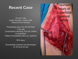Recent Case
25 year male
Apollo Hospital, Jubilee Hills
Referred from Nanded
Penetrating injury into the left thigh
1 day ago
Compression dressing, first aid, shifted
to hyderabad
Patient immediately taken up, explored
SFA injury
Successfully repaired and discharged
on 3rd post op day
 