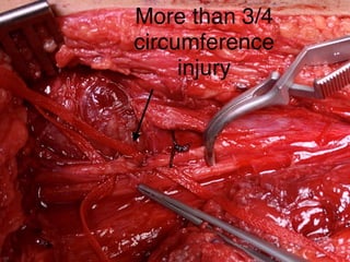 Lower Limb Vascular Trauma - Brief 