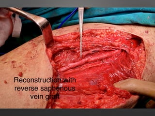 Lower Limb Vascular Trauma - Brief 