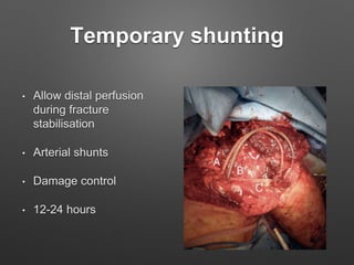 Temporary shunting
• Allow distal perfusion
during fracture
stabilisation
• Arterial shunts
• Damage control
• 12-24 hours
 