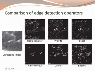 Comparison of edge detection operators
10/23/2016 31
Ultrasound image
Basic operator Prewitt Sobel
Marr-Hildreth Canny Spacek
 