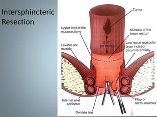 Intersphincteric
Resection
 