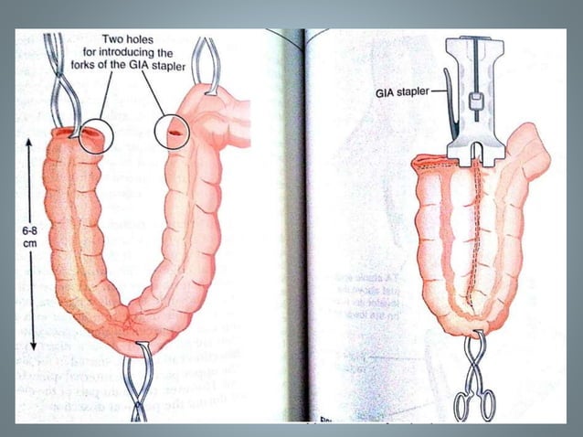 Low Anterior Resection | PPTX | Surgery | Medical Health