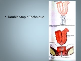 • Double Staple Technique
 