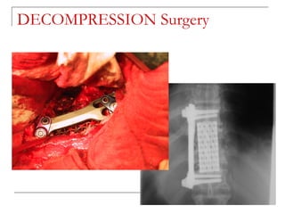 DECOMPRESSION Surgery
 