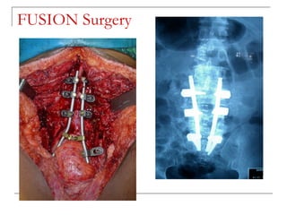 FUSION Surgery
 