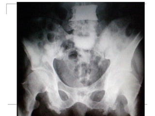 Plain x-rays
 