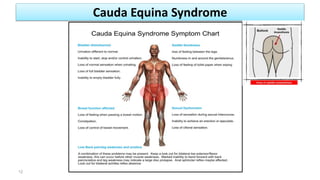 Cauda Equina Syndrome
12
 