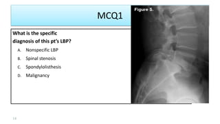MCQ1
What is the specific
diagnosis of this pt’s LBP?
A. Nonspecific LBP
B. Spinal stenosis
C. Spondylolisthesis
D. Malignancy
14
 