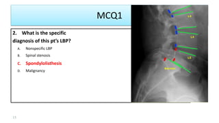 MCQ1
2. What is the specific
diagnosis of this pt’s LBP?
A. Nonspecific LBP
B. Spinal stenosis
C. Spondylolisthesis
D. Malignancy
15
 