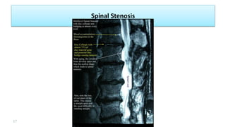 Spinal Stenosis
17 background
 