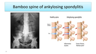 Bamboo spine of ankylosing spondylitis
44
 