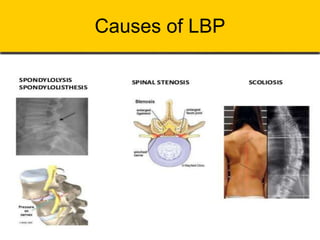 Causes of LBP
 