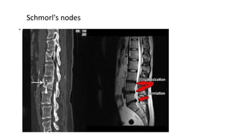 Schmorl's nodes
 