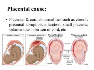 Placental cause:
• Placental & cord abnormalities such as chronic
placental abruption, infarction, small placenta,
velamentous insertion of cord, etc
32
 