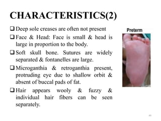 CHARACTERISTICS(2)
Deep sole creases are often not present
Face & Head: Face is small & head is
large in proportion to the body.
Soft skull bone. Sutures are widely
separated & fontanelles are large.
Microganthia & retroganthia present,
protruding eye due to shallow orbit &
absent of buccal pads of fat.
Hair appears wooly & fuzzy &
individual hair fibers can be seen
separately.
49
 