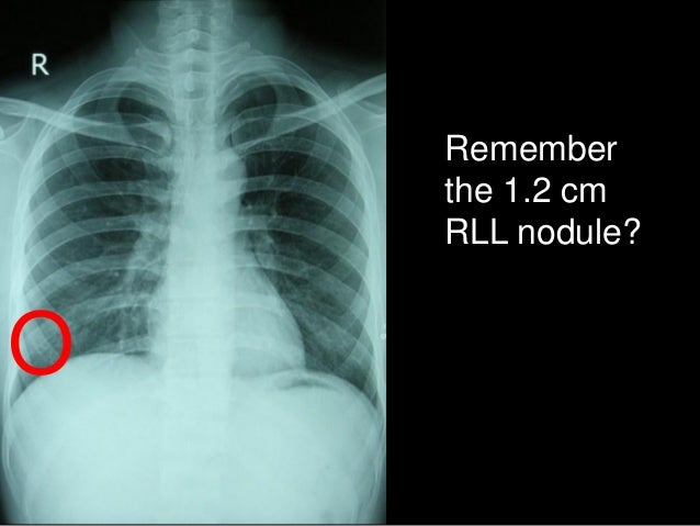 Low dose ct lung cancer screening update