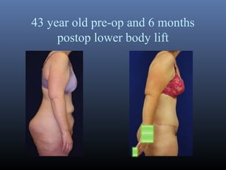 43 year old pre-op and 6 months
postop lower body lift

 