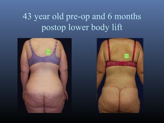 43 year old pre-op and 6 months
postop lower body lift

 