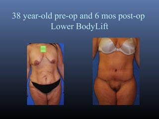 38 year-old pre-op and 6 mos post-op
Lower BodyLift

 