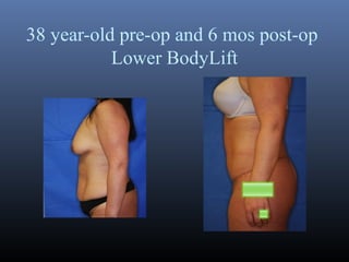 38 year-old pre-op and 6 mos post-op
Lower BodyLift

 