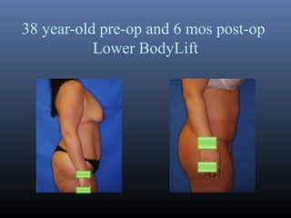 38 year-old pre-op and 6 mos post-op
Lower BodyLift

 