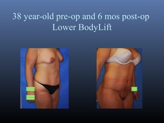 38 year-old pre-op and 6 mos post-op
Lower BodyLift

 